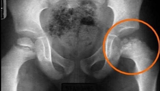 Doença de Perthes-Dr-David-Nordon-Ortopedista-Infantil
