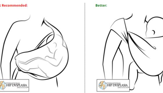 Sling-causa-problemas-de-quadril-Dr-David-Nordon-Ortopedista-Infantil