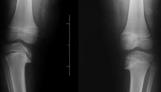 doença de blount – Dr. David Nordon