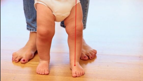 Joelhos tortos quando devo me preocupar-Dr-David-Nordon-Ortopedista-Infantil