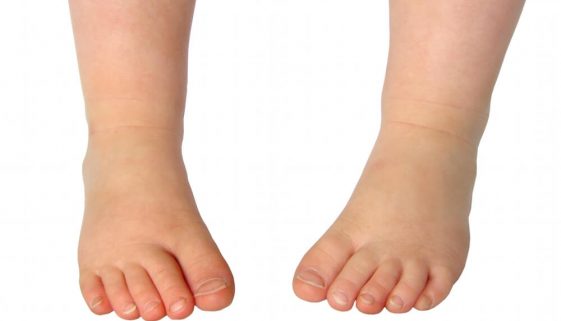 Metatarso Aduto-Dr-David-Nordon-Ortopedista-Infantil