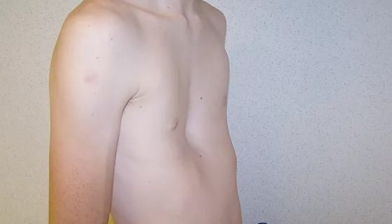 Pectus excavatum-Dr-David-Nordon-Ortopedista-Infantil