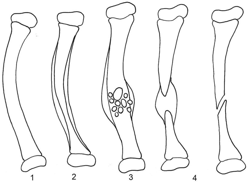 Pseudoartrose Congênita de Tíbia – Dr. David Nordon