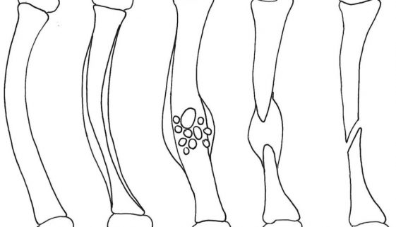 Pseudoartrose Congênita de Tíbia-Dr-David-Nordon-Ortopedista-Infantil