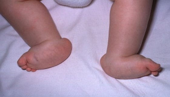 Pé talo vertical-Dr-David-Nordon-Ortopedista-Infantil